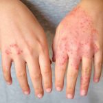 Image of a pair of hands with eczema.