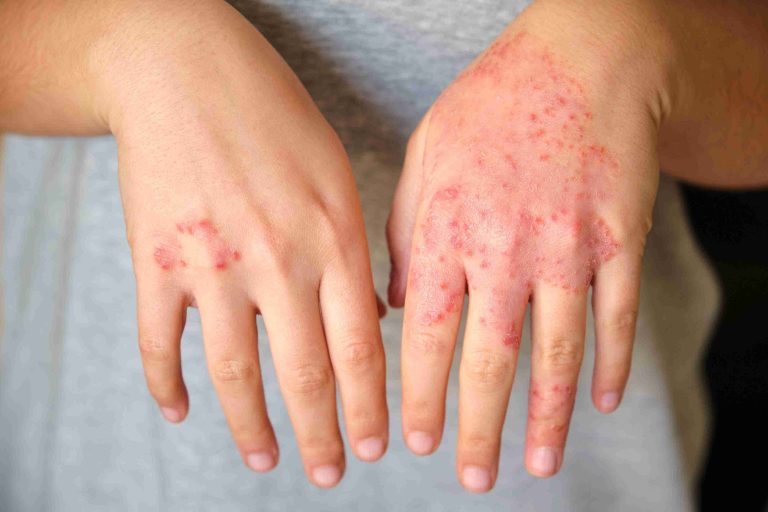Image of a pair of hands with eczema.
