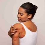 Woman with skin irritation on her shoulder and back.