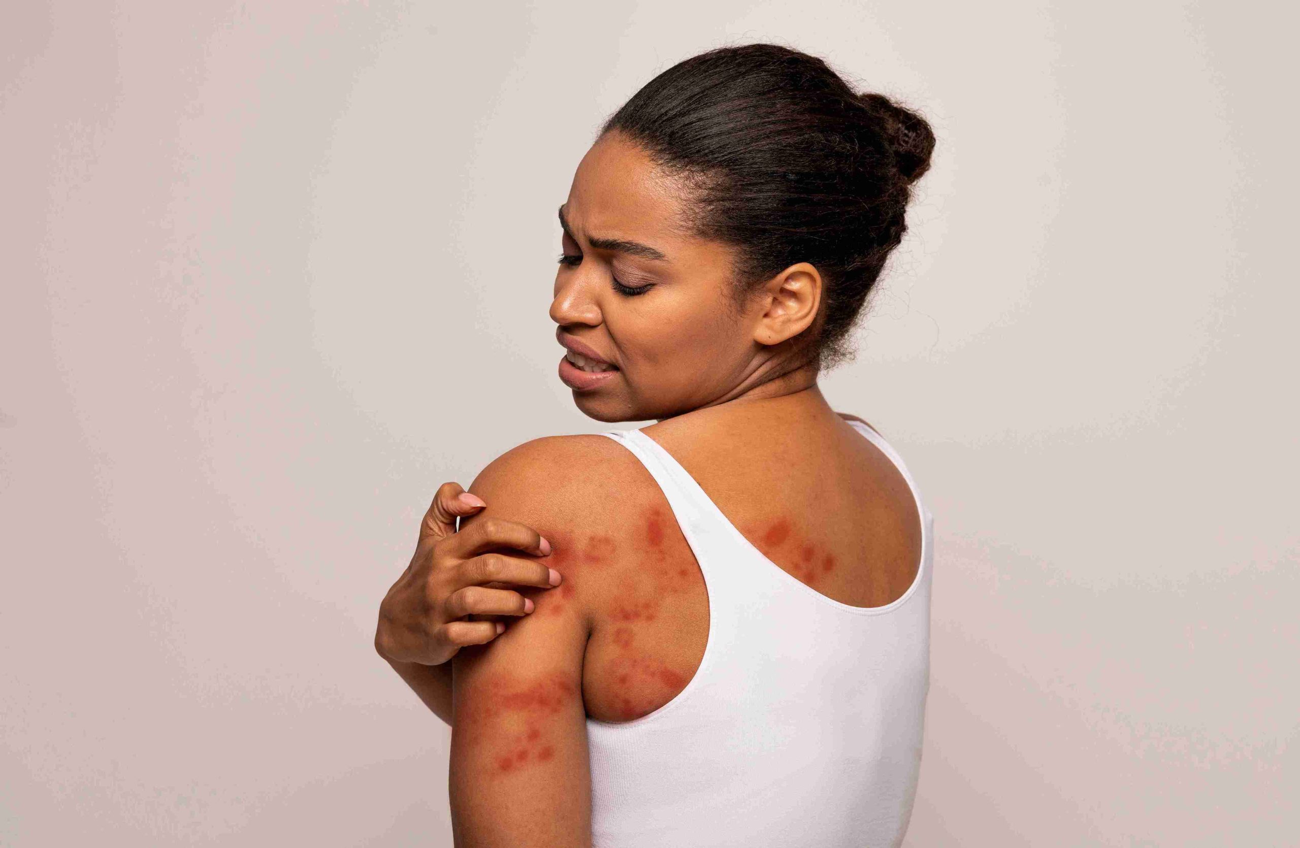 Woman with skin irritation on her shoulder and back.